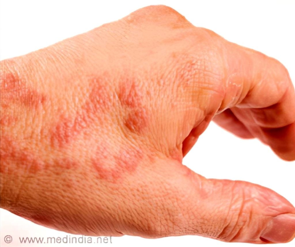 Fig 2.1-4: Dermatitis [Inflammation of skin] due to chlorine exposure