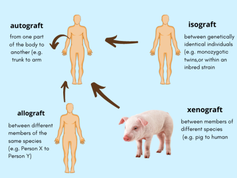 Types of organ transplant