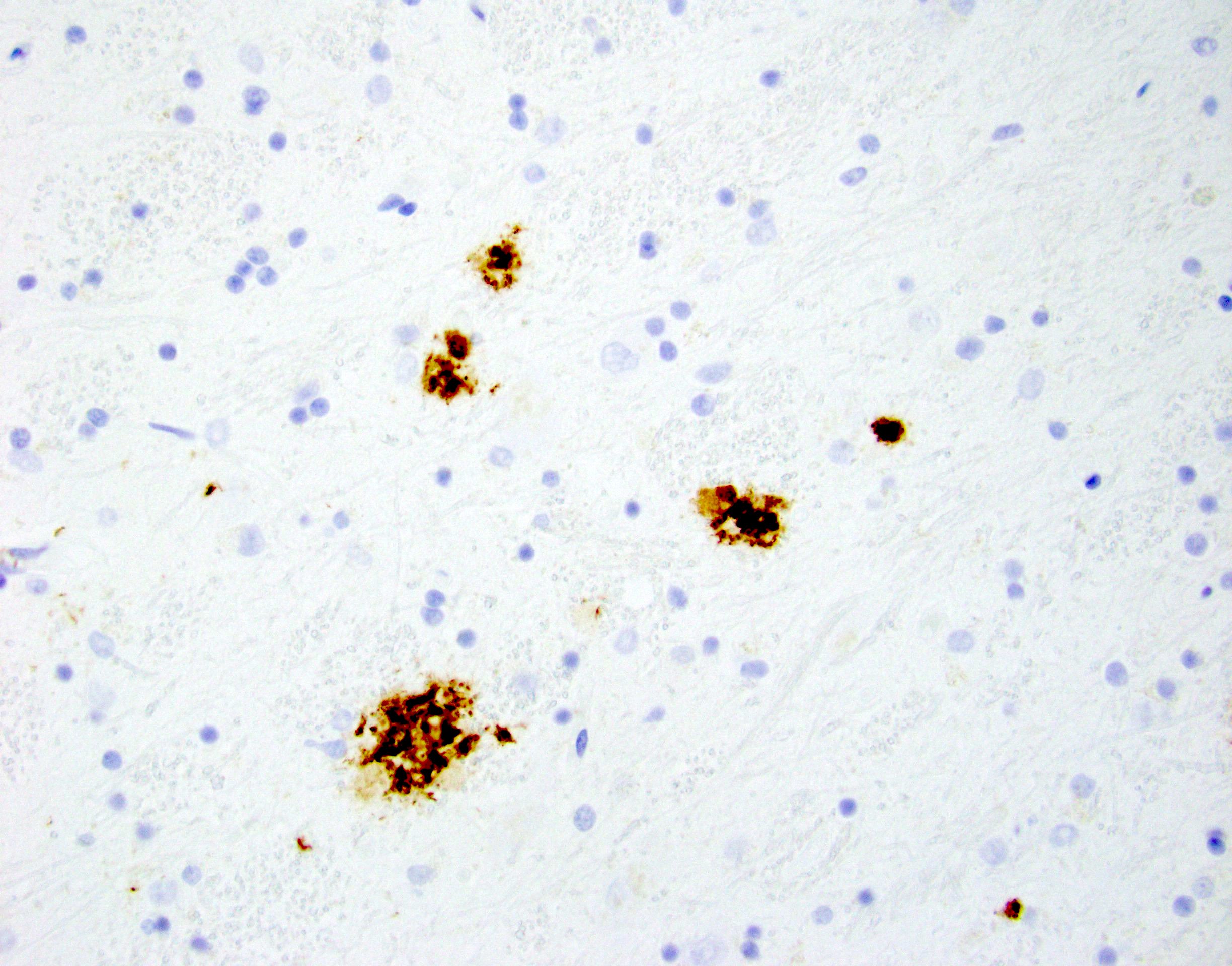 alzheimerWhite12